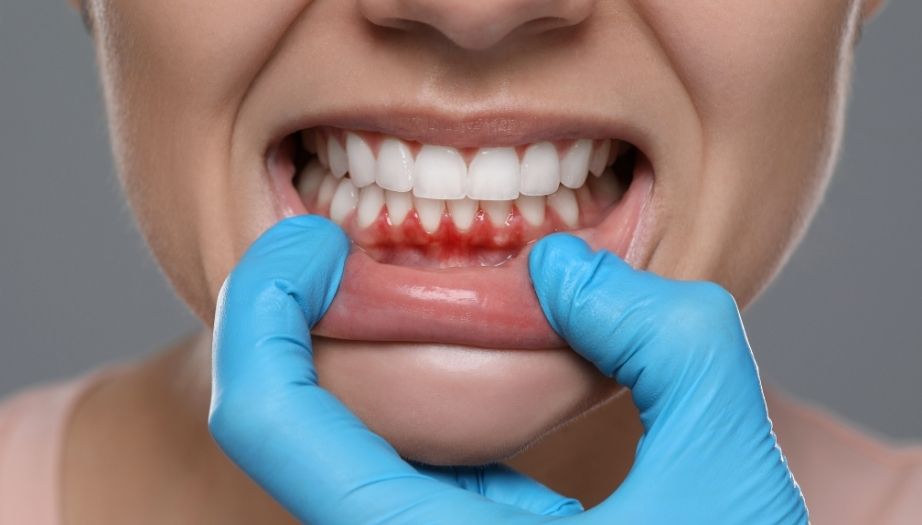 diş eti kanaması, diş eti hastalığı, diş eti çekilmesi, diş eti neden kanar, diş eti tedavisi, diş kanaması çözümü, periodontitis belirtileri, diş eti hijyeni, evde ağız bakımı